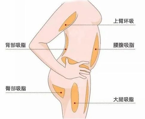 腰部吸脂减肥价格  