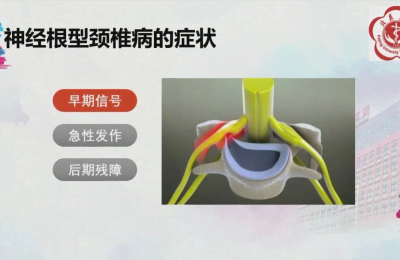 神经根型颈椎病最严重的症状  