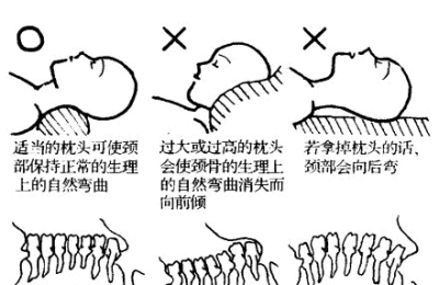 颈椎病睡姿图片大全  