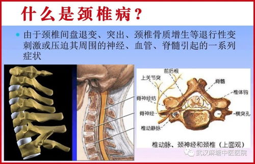 颈椎病哪里看的好 